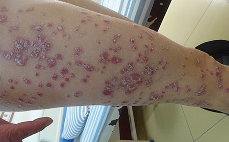 银屑病患者怎么护理