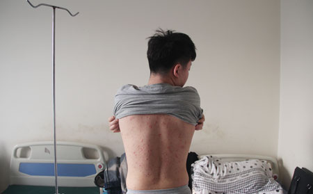 银屑病怎么治疗