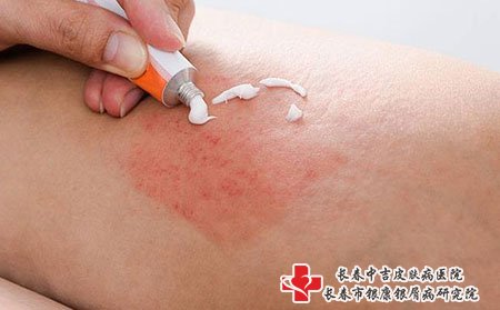 长春银康研究院,牛皮癣的治疗方法,牛皮癣有哪些治疗方法,牛皮癣治疗方法是什么