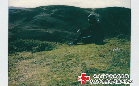 脸部银屑病有什么方法治，长春银康医院能治好吗?