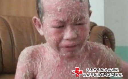 银屑病的发病原因_长春银康研究院