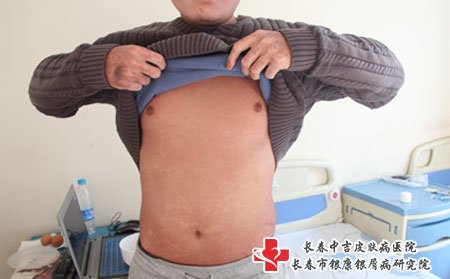 银屑病反复的原因_长春银康研究院