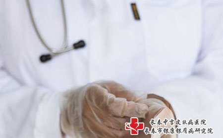 长春银康银屑病研究院谈牛皮癣检查要注意哪些