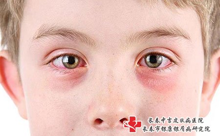 银屑病容易出现在些什么部位