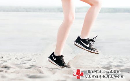 治疗牛皮癣的常见方法有哪些