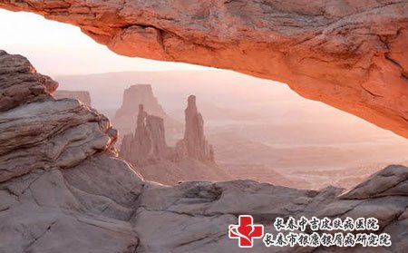 银屑病症状多久能消退，预防复发的方法