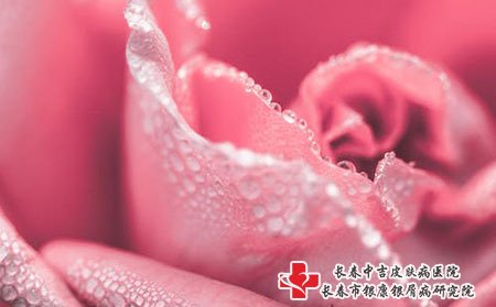银屑病的治疗时间要多久能好