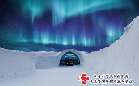 脸上牛皮癣用什么药有效果