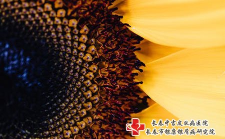 选择一家好的医院，治好牛皮癣就事半功倍